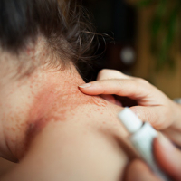 Home Remedies For Eczema